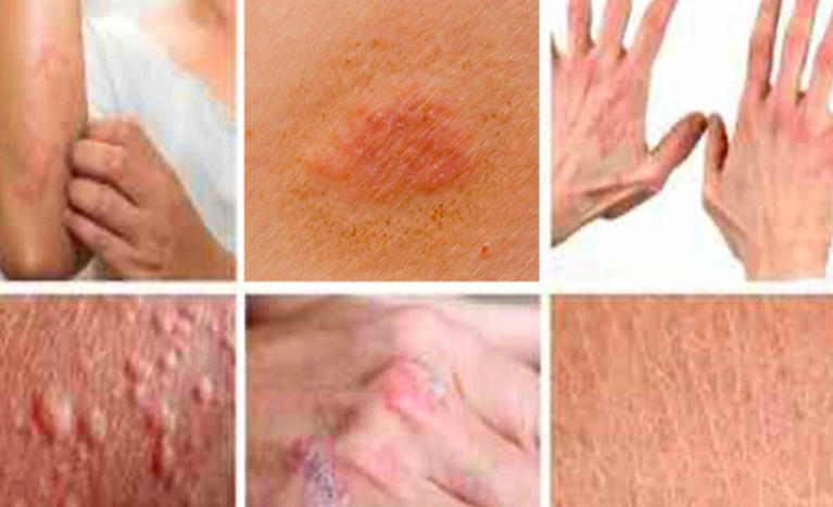 مەترسیدارترین نەخۆشیەکانی  پێست ، کامانەن؟؟  